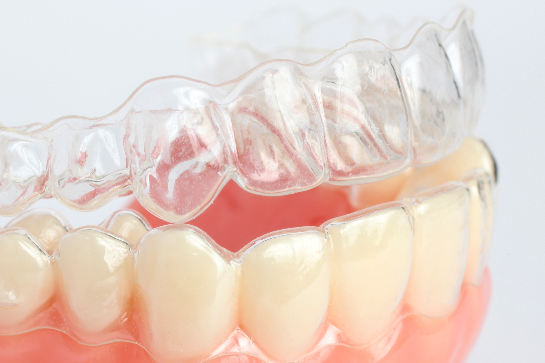 clear aligner on teeth | invisalign tanglewood