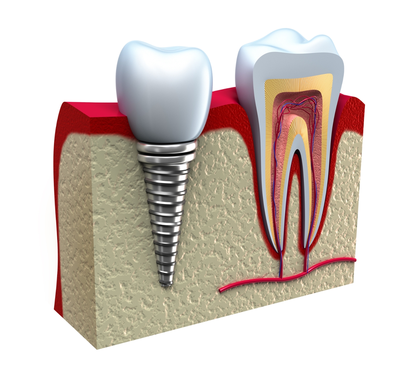 interior of dental implant | dental implants tanglewood