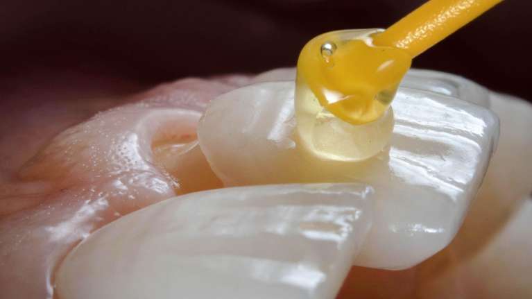 Dental Veneers