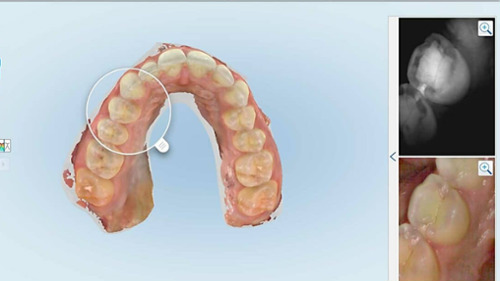 close up image of intraoral scanning | dentist uptown