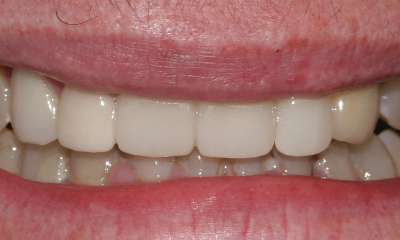 Four-teeth-veneers-After-Image