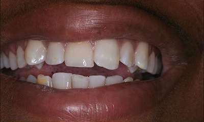 Single-tooth-colored-filling-After-Image
