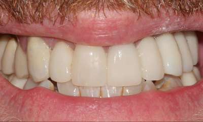 Three-dental-implants-and-crowns-After-Image
