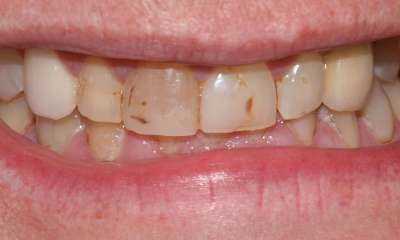 Four-teeth-veneers-Before-Image