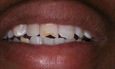 Single-tooth-colored-filling-Before-Image