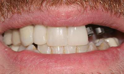 Three-dental-implants-and-crowns-Before-Image