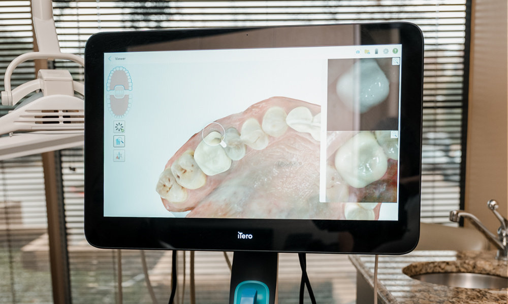 iTero intraoral scanner display showing a detailed 3D digital scan of teeth in a dental treatment room